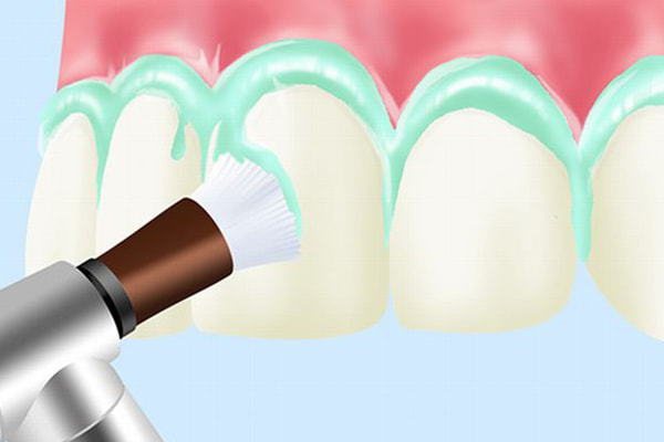 天然歯へのフッ素塗布